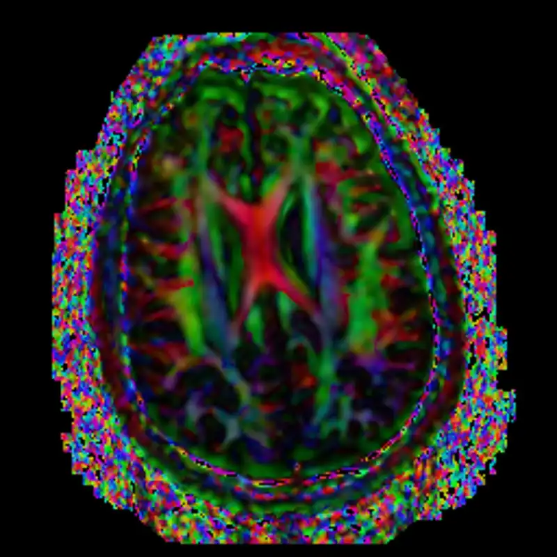 cerebral vascular disease